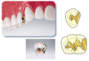 保険適用【インレー（ゴールド）】
